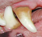 stage 2 dental disease